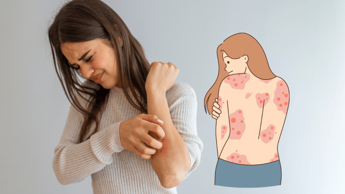 The Causes of Psoriasis Outbreaks Triggers and Management