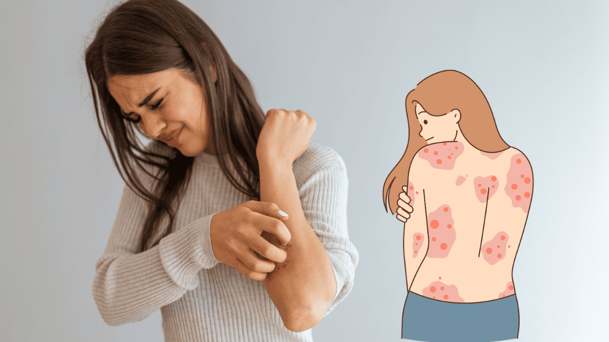 Psoriasis Symptoms, Treatments, and Management Tips